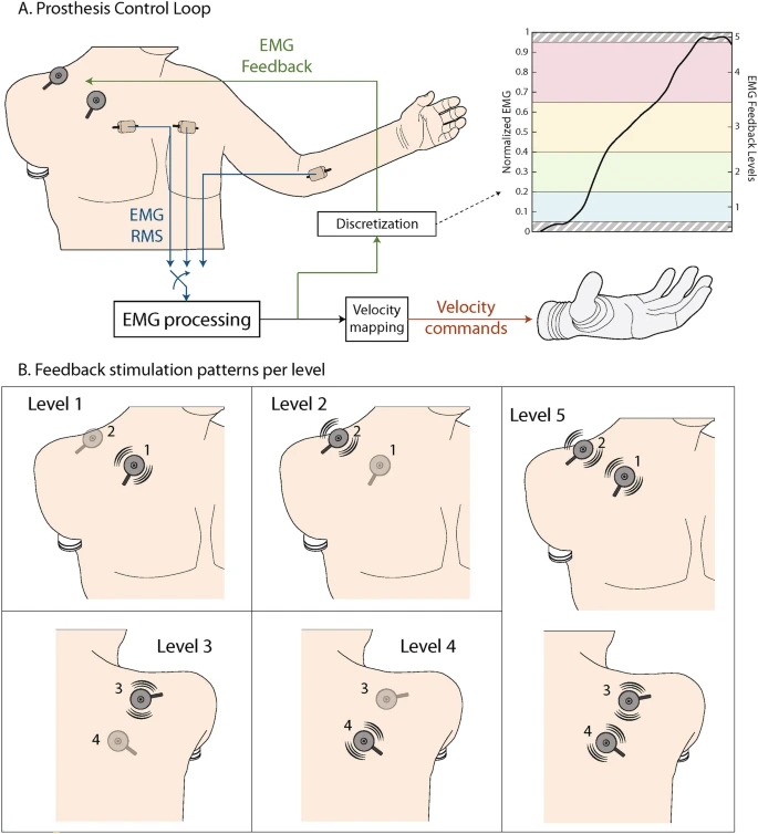 Figure 1. Application of EMG feedback for hand prosthesis control in high-level amputation: a case study [10]