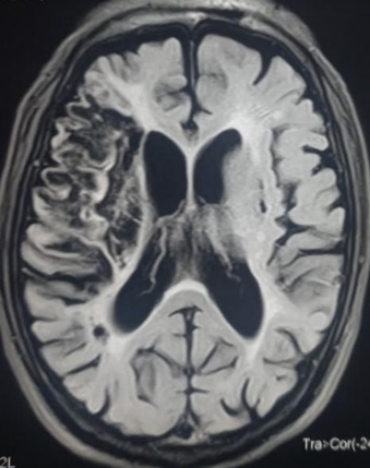 Figure 2. Image of the brain of an ischemic stroke patient [4].