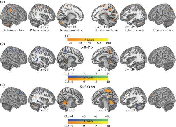 Figure 3. The principal fMRI analysis focused on identifying brain activity associated with blushing. (a) Displays regions where estimated parameters for viewing and singing correlated with individual variations in cheek temperature changes(b and c) Highlight areas exhibiting significant differences in individual variability of cheek temperature fluctuations related to singer identity.